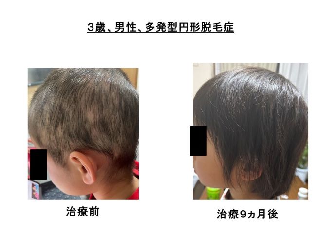 円形脱毛症　病院